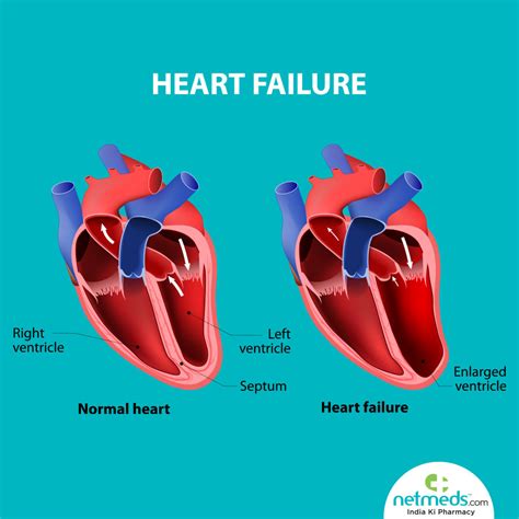 what does lv dysfunction mean